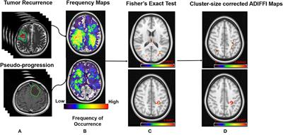 Can Tumor Location on Pre-treatment MRI Predict Likelihood of Pseudo-Progression vs. Tumor Recurrence in Glioblastoma?—A Feasibility Study